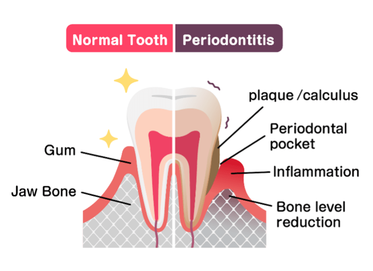 Normal Tooth - Periodontitis